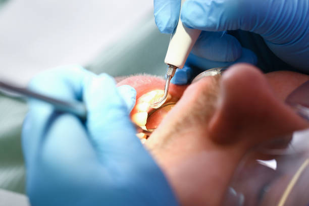 Best Emergency Wisdom Teeth Removal in Carrizo Springs, TX